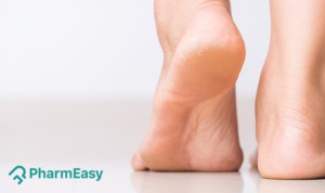 home remedies for cracked heels