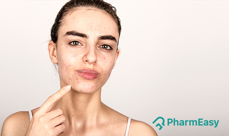 home remedies for acne scars