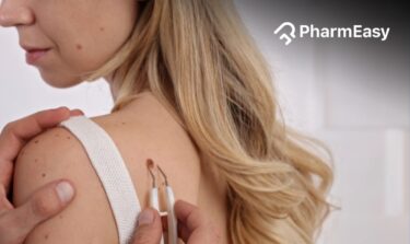 how to get rid of skin tags