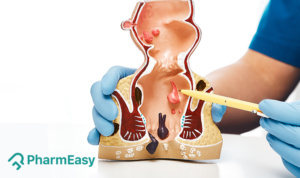 anal fissure home remedy