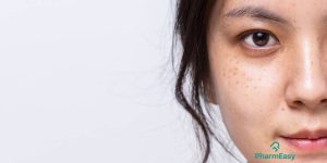 home remedies for freckles