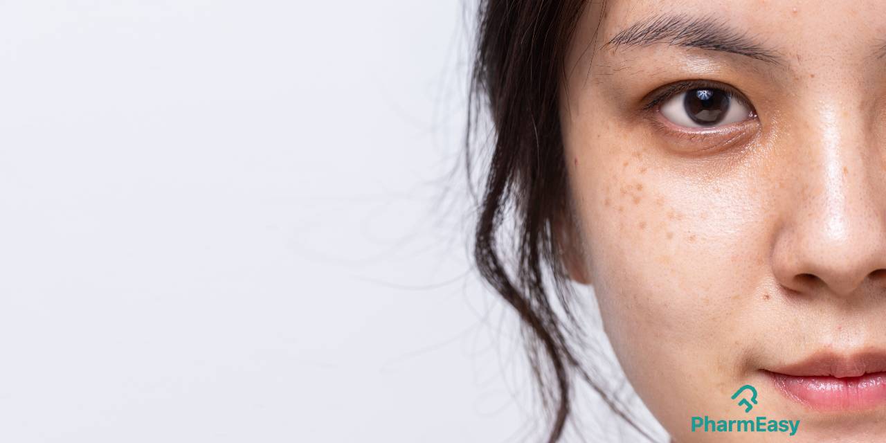 home remedies for freckles